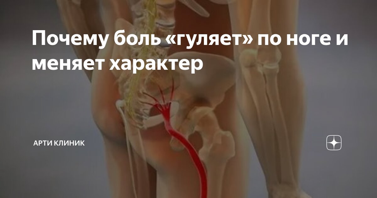 Почему боль «гуляет» по ноге и меняет характер