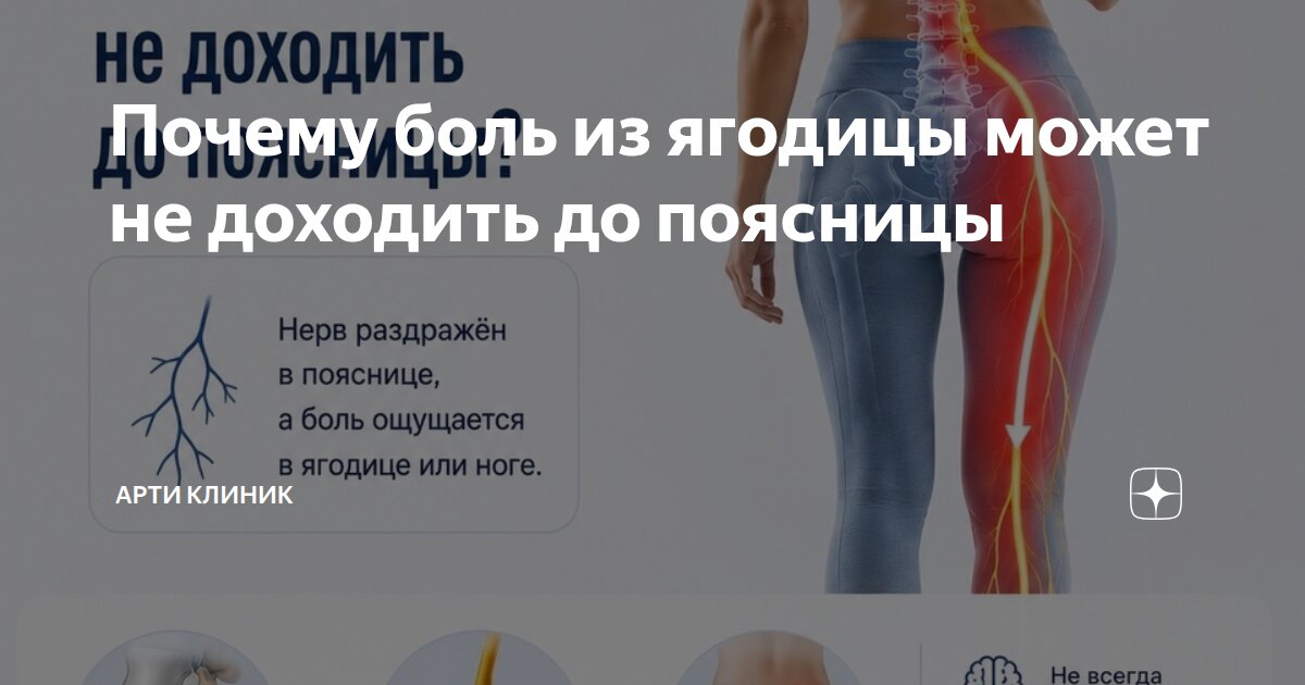 Почему боль из ягодицы может не доходить до поясницы
