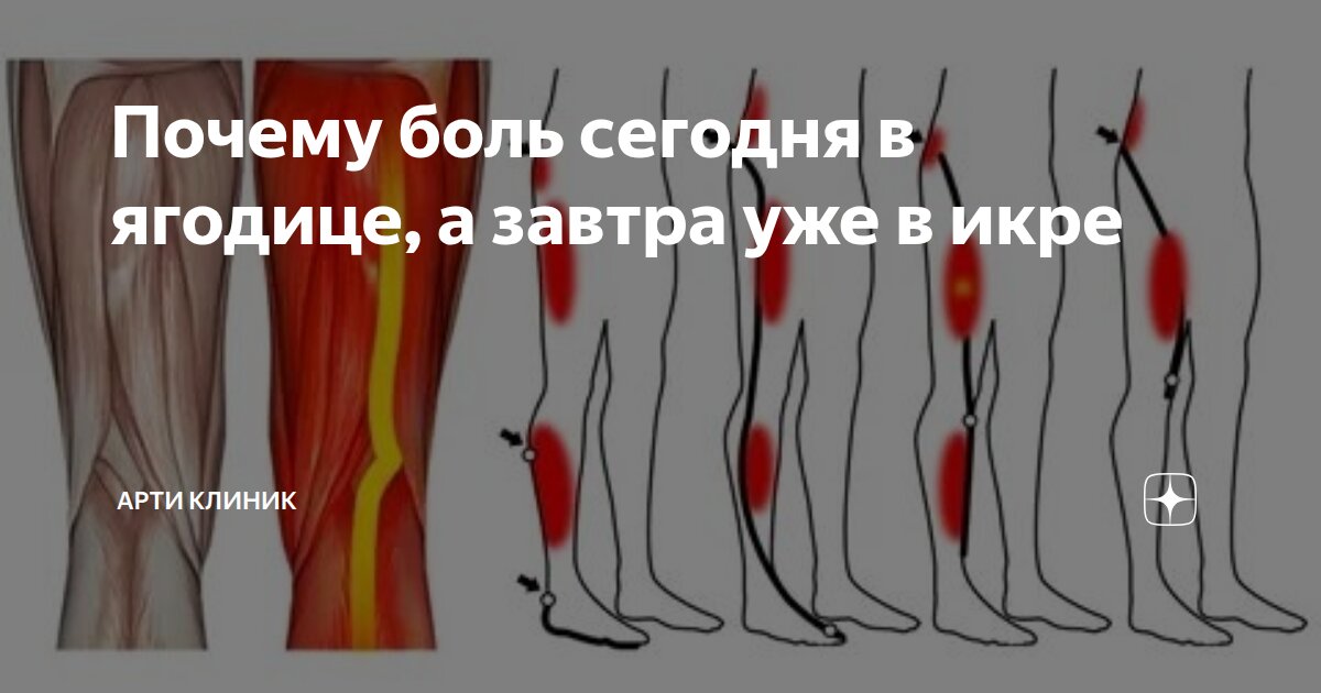 Почему боль сегодня в ягодице, а завтра уже в икре