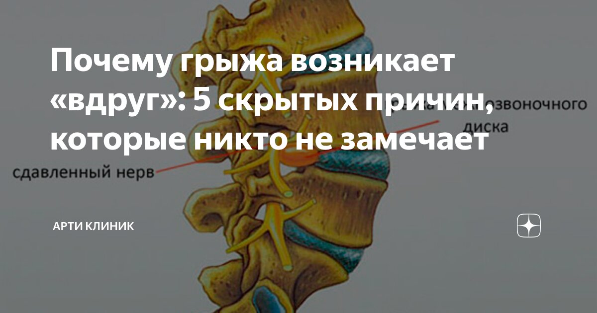 Почему грыжа возникает «вдруг»: 5 скрытых причин, которые никто не замечает