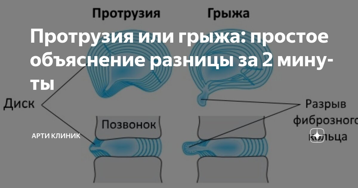 Протрузия или грыжа: простое объяснение разницы за 2 минуты