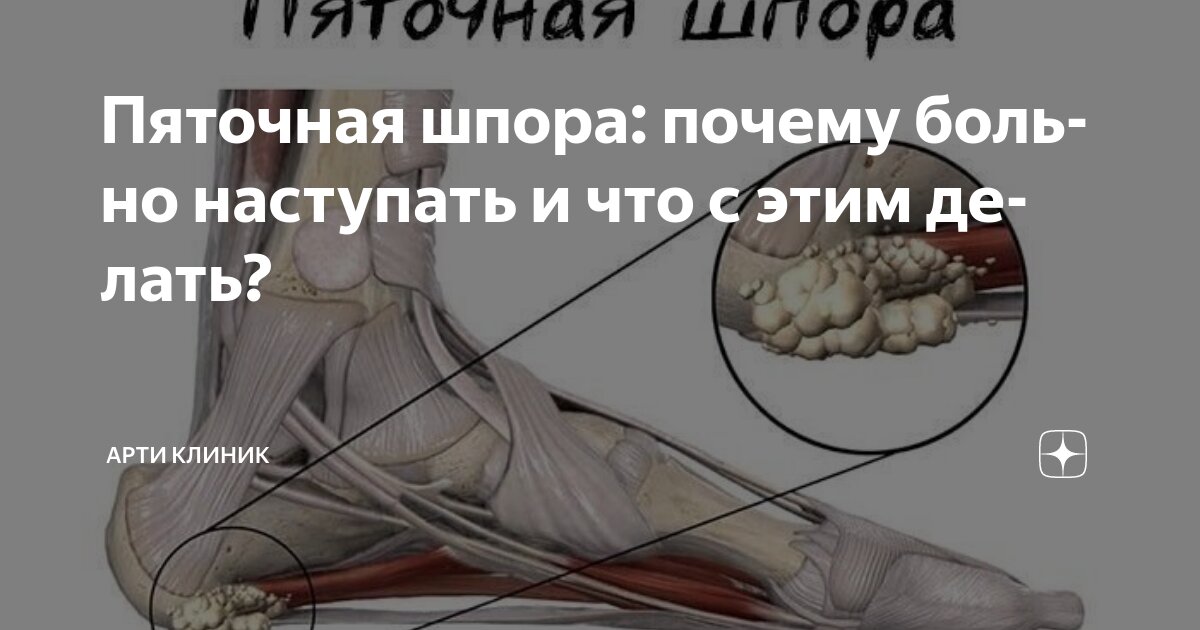 Пяточная шпора: почему больно наступать и что с этим делать?