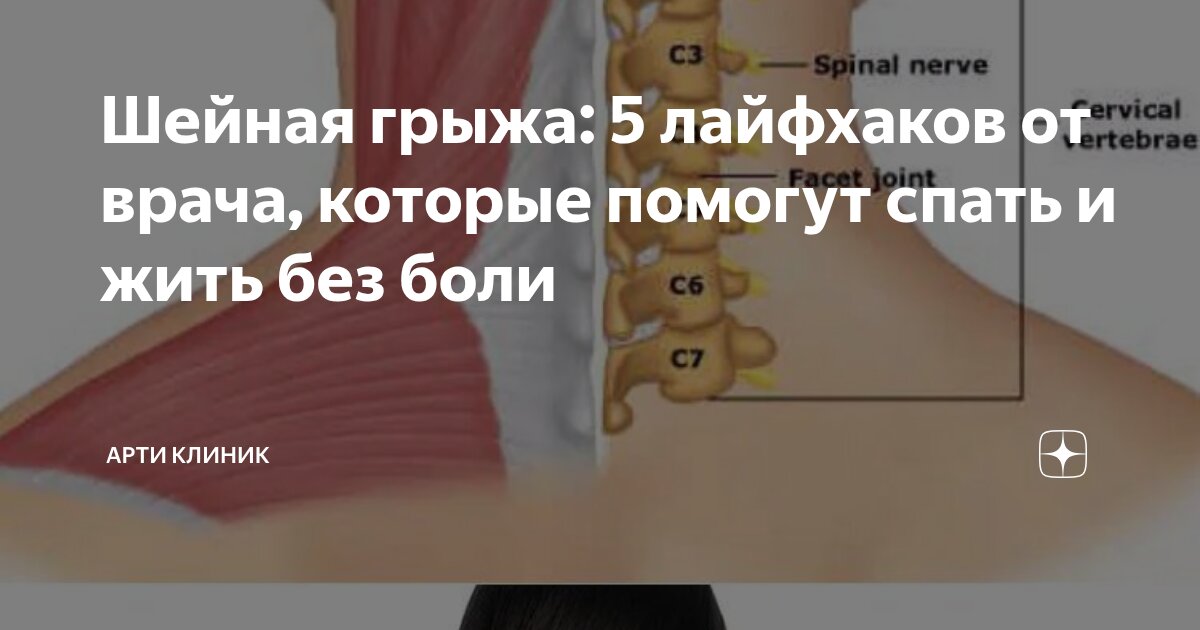 Шейная грыжа: 5 лайфхаков от врача, которые помогут спать и жить без боли