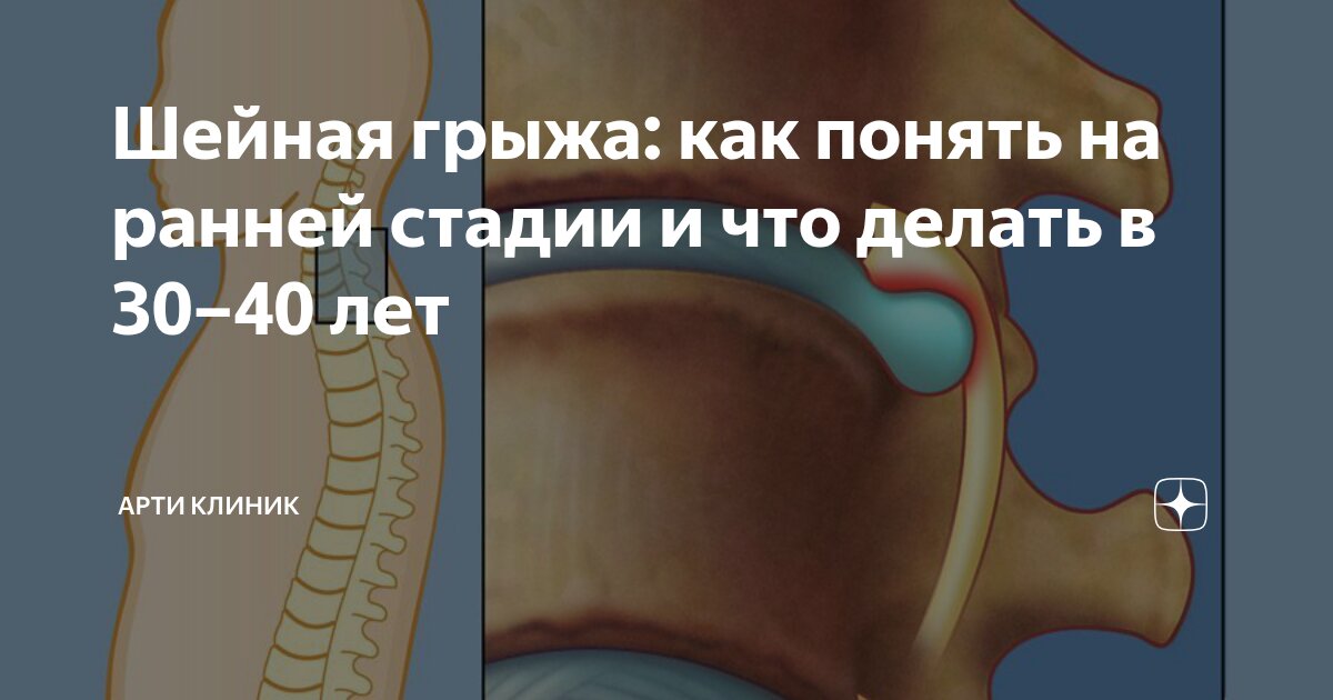 Шейная грыжа: как понять на ранней стадии и что делать в 30–40 лет