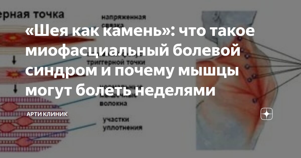 «Шея как камень»: что такое миофасциальный болевой синдром и почему мышцы могут болеть неделями
