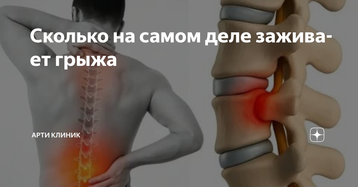 Сколько на самом деле заживает грыжа