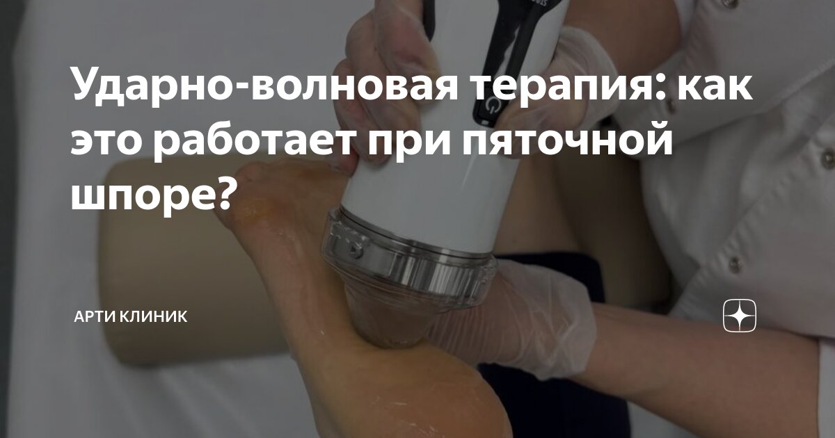 Ударно-волновая терапия: как это работает при пяточной шпоре?